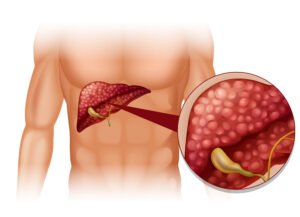 Ilustración médica del hígado graso o esteatosis hepática mostrando acumulación de grasa en las células del hígado junto a la vesícula biliar